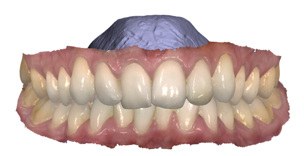 Escaner intraoral 3D